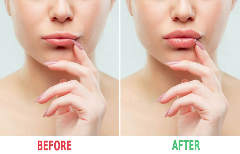 Before And After Lips Lifting