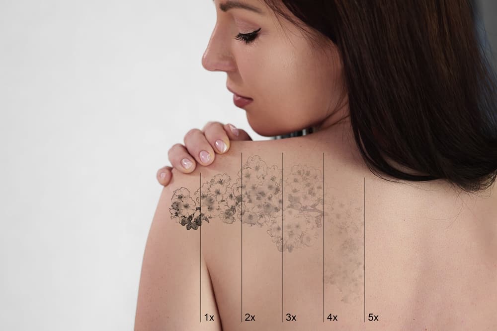 Laser Tattoo Removal On Woman's Shoulder